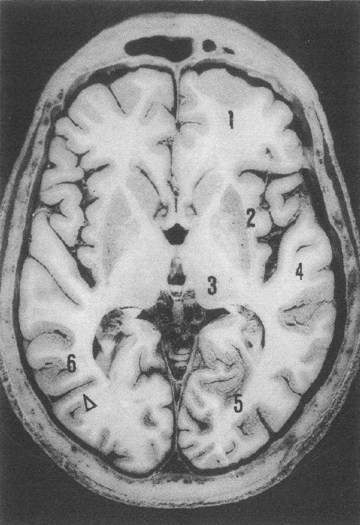 大脑水平切面解剖图片图片